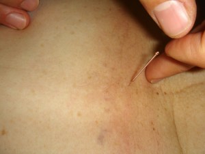 acupuncture-289251_1280